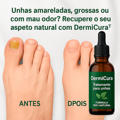 Aceite anti-hongos uñas